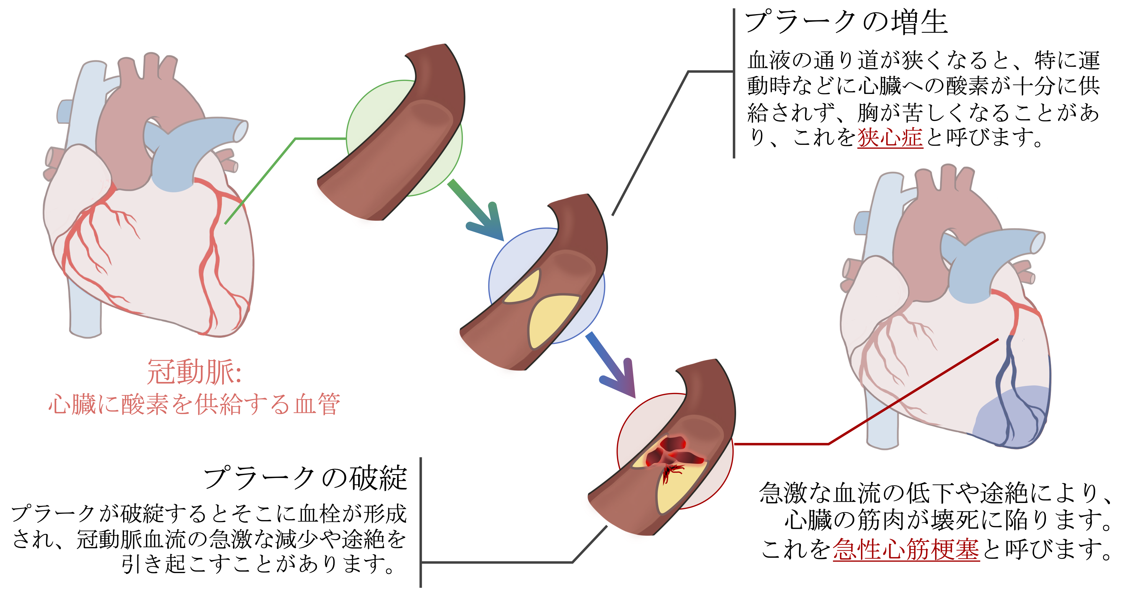 虚 血性 心 疾患