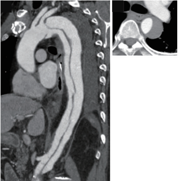 Aortic Aneurysm/Aortic Dissection - 聖路加国際病院 心血管センター